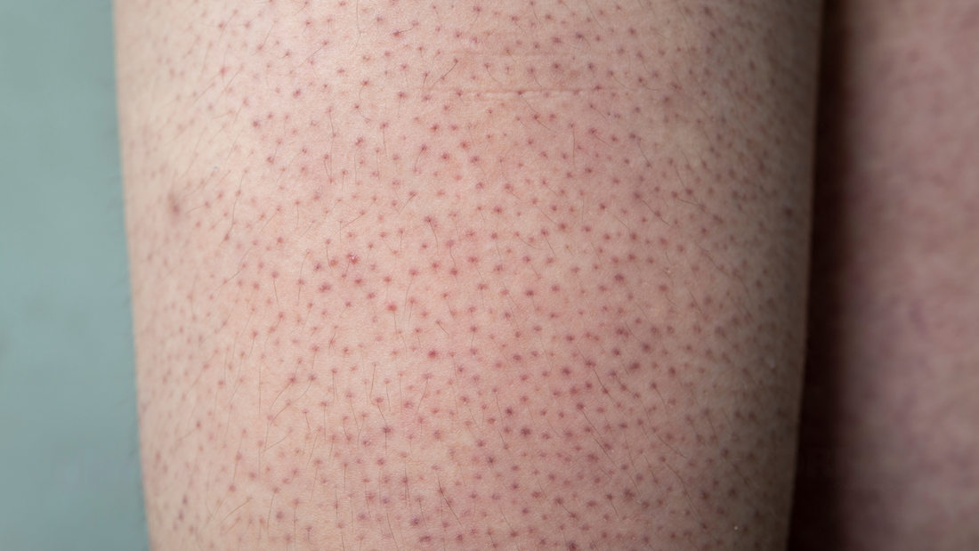 Bumpy Skin Breakthrough: Unexpected Help for Keratosis Pilaris