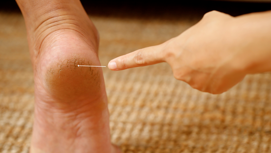 Why Are My Heels Cracked? Common Causes and Solutions