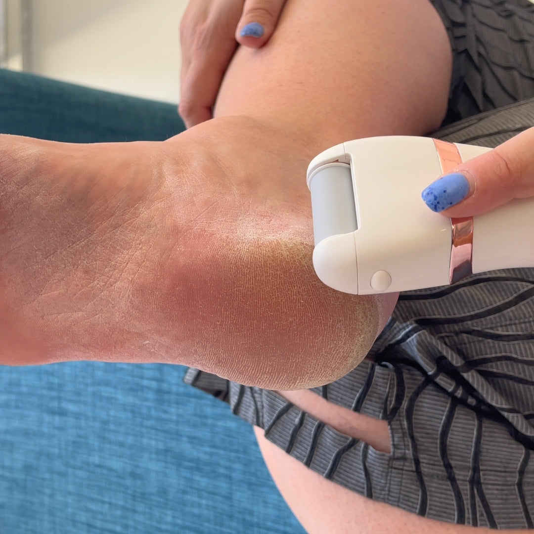 Dermelive Pedi Pro in Action