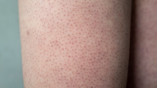 Bumpy Skin Breakthrough: Unexpected Help for Keratosis Pilaris