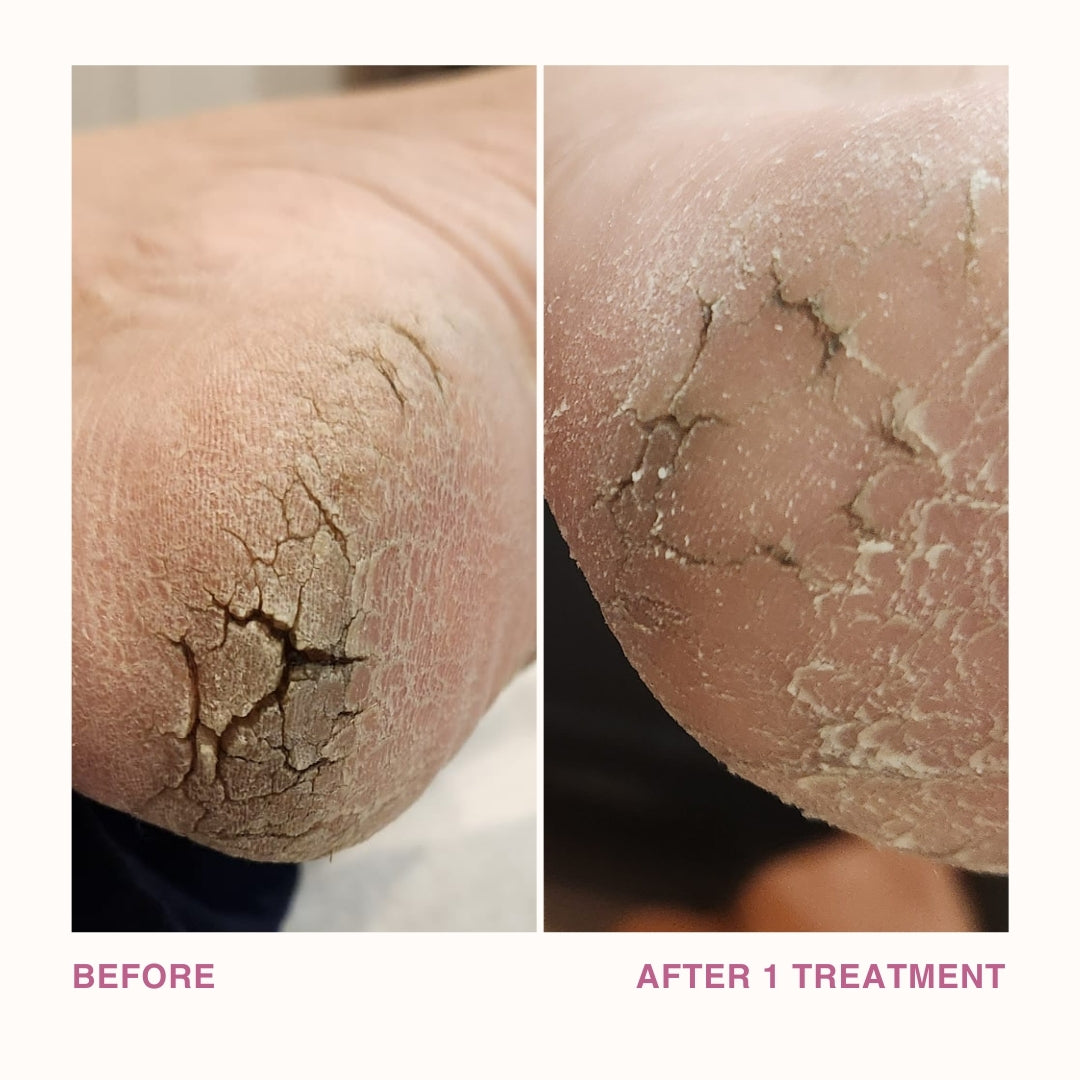 Before and After Cracked Heels with 1 Use
