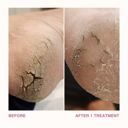 Before and After Cracked Heels with 1 Use