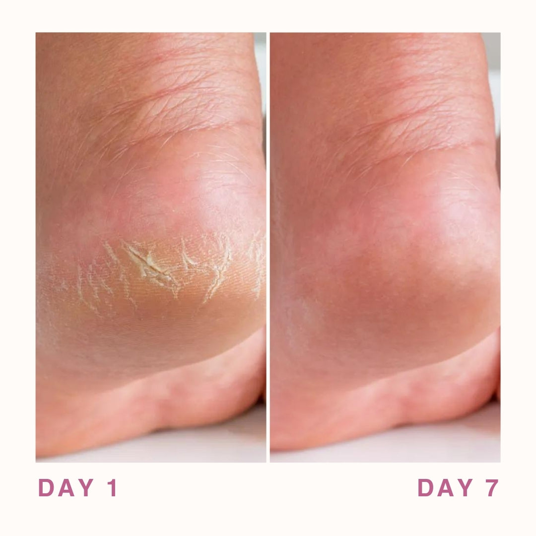 Before and After Image with 7 Days Treatment of Cracked Heels 